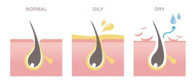  Acne-Prone and Oily Skin